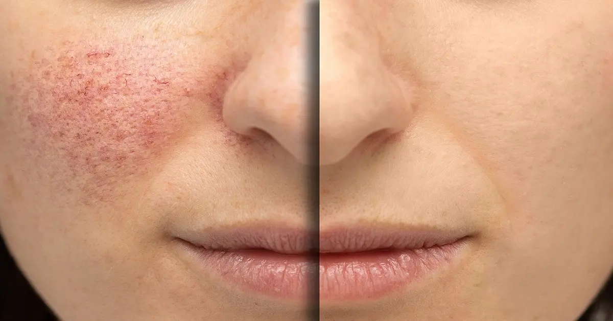Dermatica Azelaic Acid Before and After